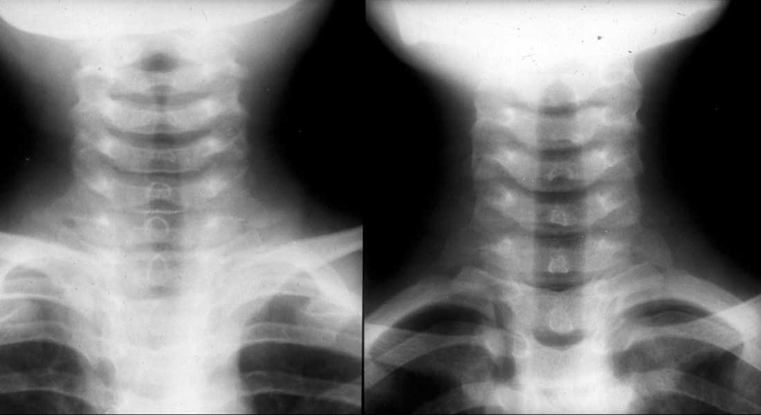 Radiografia cervical AP no crupe e normal