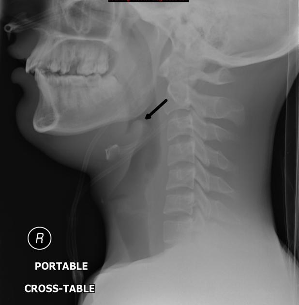 Radiografia cervical em perfil com sinal do polegar