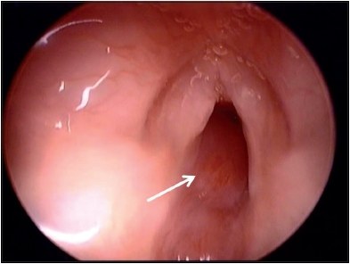 Hemangioma subglótico na endoscopia