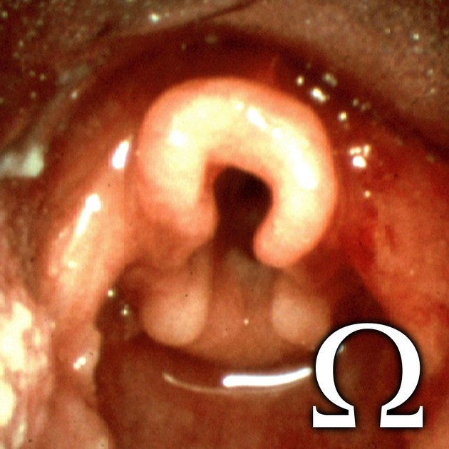 Epiglote em ômega na laringomalácia