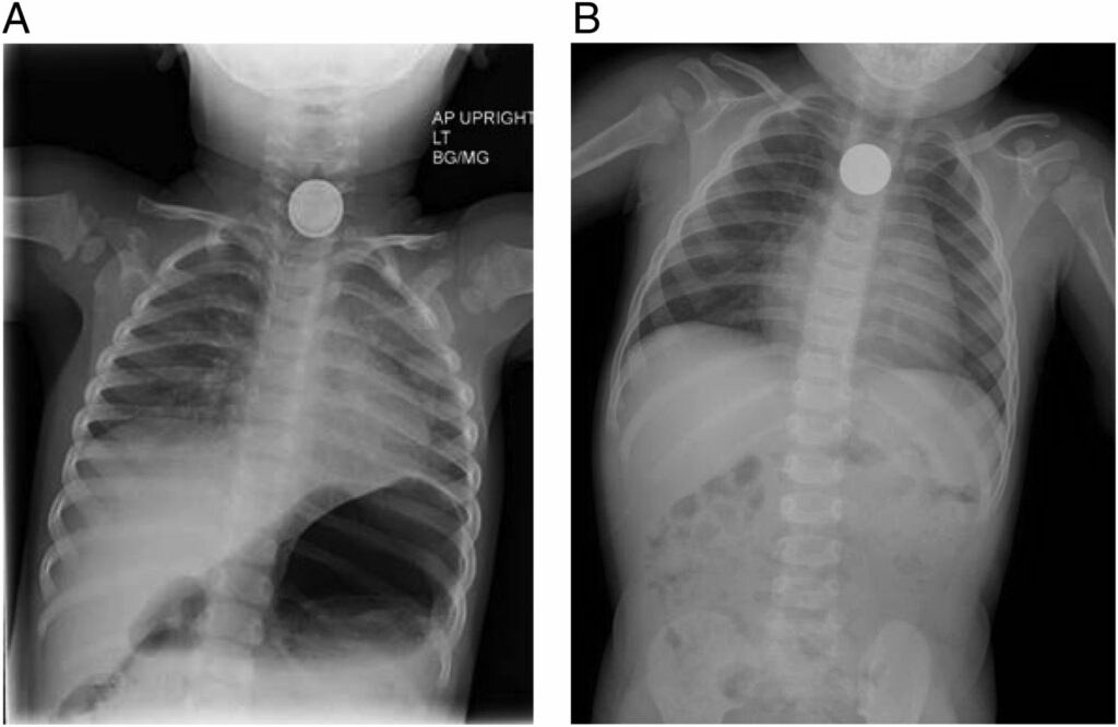 Moeda no esôfago em radiografia AP